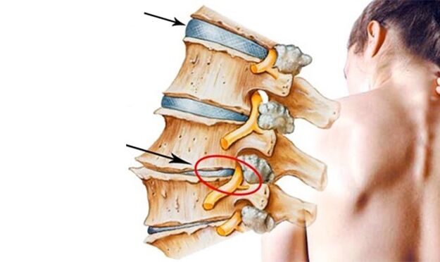 Pinched nerve in the spine as a cause of lower back pain