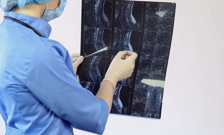 The diagnosis of cervical osteochondrosis is made on the basis of an MRI scan