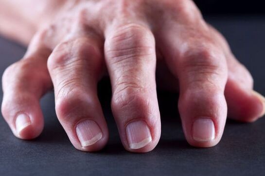 Joint deformities of the fingers due to osteoarthritis or arthritis